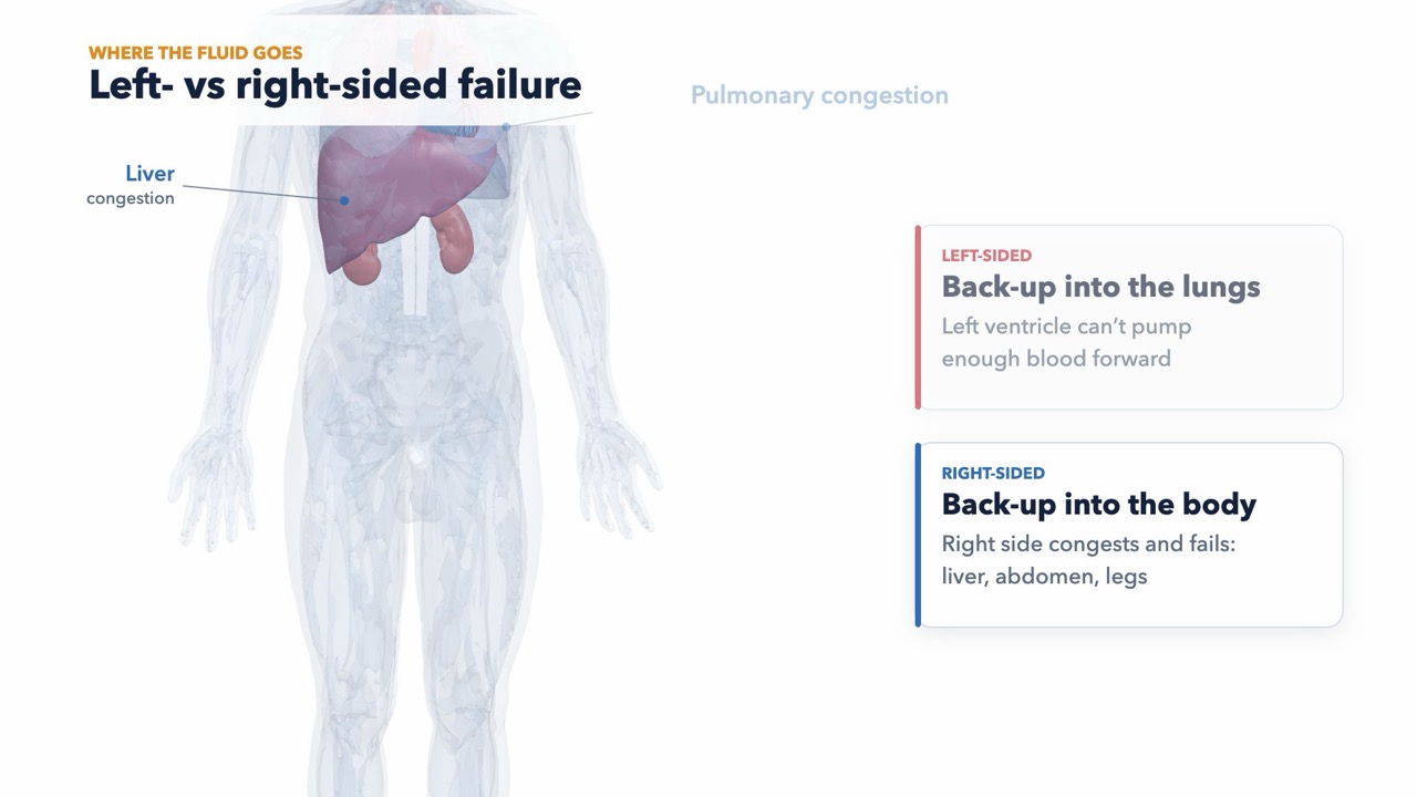 Lesson frame: left vs right sided heart failure in a 3D body
